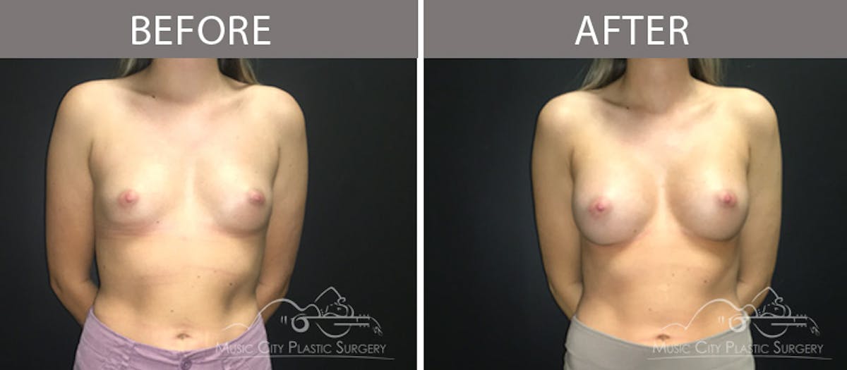 Breast Augmentation Before & After Gallery - Patient 90709269 - Image 1