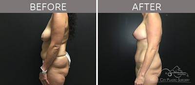 Breast Lift with Augmentation Before & After Gallery - Patient 132099615 - Image 3