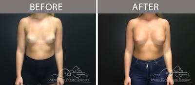 Breast Augmentation Before & After Gallery - Patient 90709271 - Image 1
