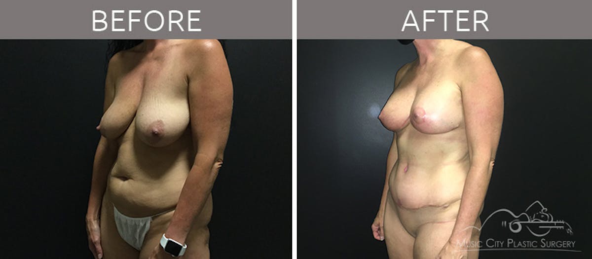 Breast Lift with Augmentation Before & After Gallery - Patient 132099615 - Image 2