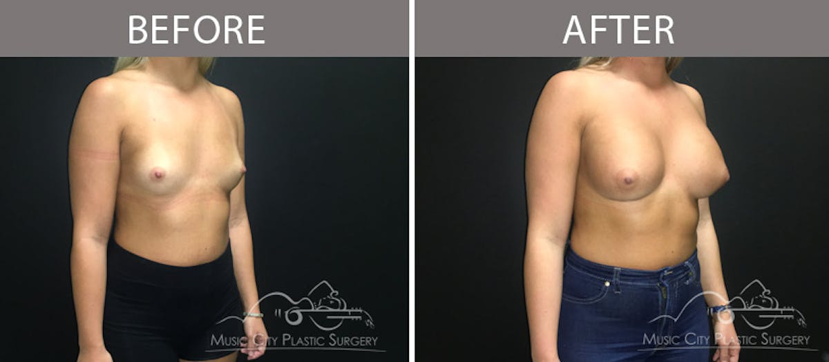 Breast Augmentation Before & After Gallery - Patient 90709271 - Image 2