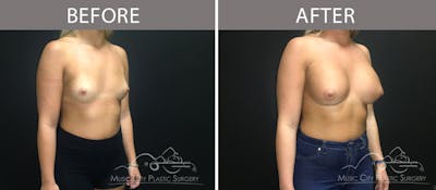 Breast Augmentation Before & After Gallery - Patient 90709271 - Image 2