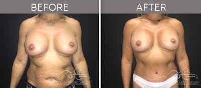 Mommy Makeover Before & After Gallery - Patient 90709272 - Image 1
