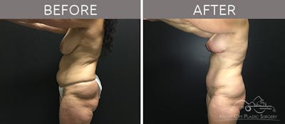 Breast Lift with Augmentation Before & After Gallery - Patient 132099615 - Image 3