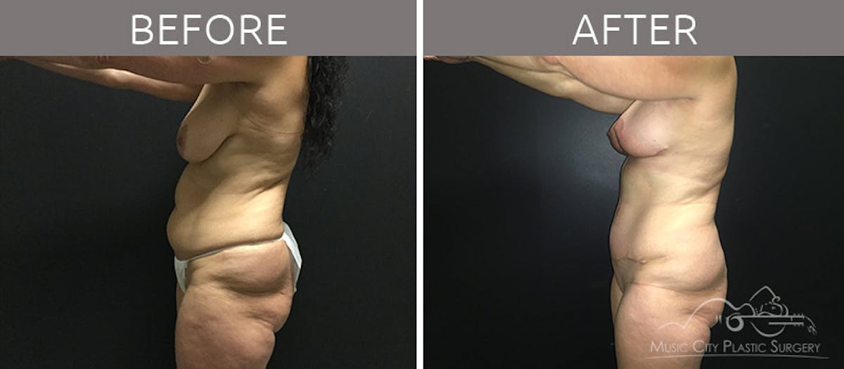 Breast Lift with Augmentation Before & After Gallery - Patient 132099615 - Image 6