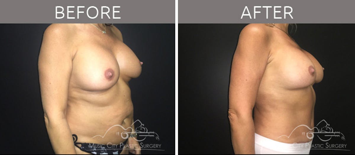 Mommy Makeover Before & After Gallery - Patient 90709272 - Image 2