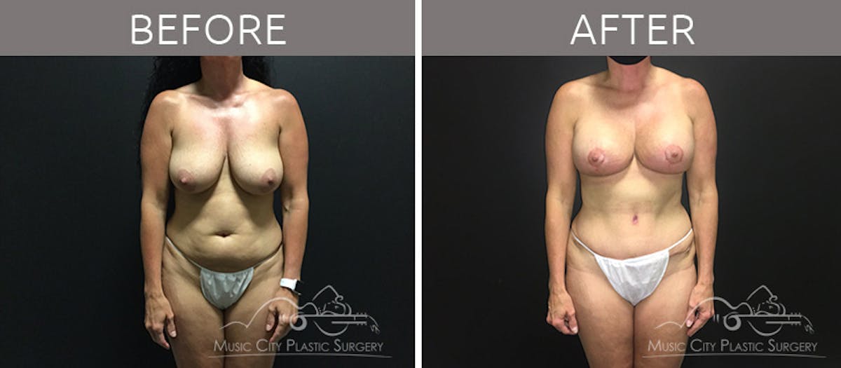 Breast Lift with Augmentation Before & After Gallery - Patient 132099615 - Image 1