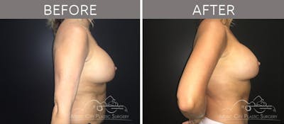 Mommy Makeover Before & After Gallery - Patient 90709272 - Image 3