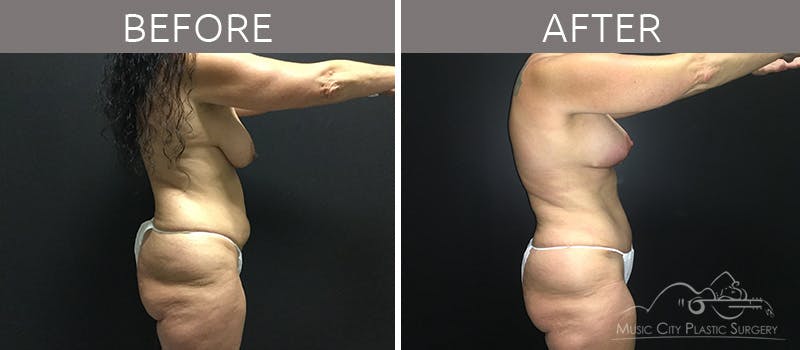 Breast Lift with Augmentation Before & After Gallery - Patient 132099615 - Image 5