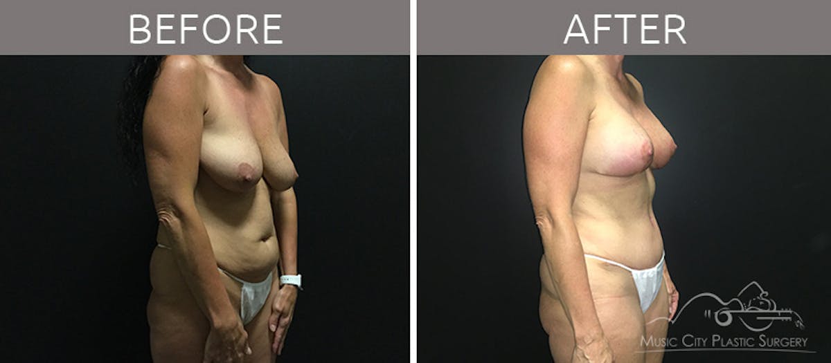 Breast Lift with Augmentation Before & After Gallery - Patient 132099615 - Image 4