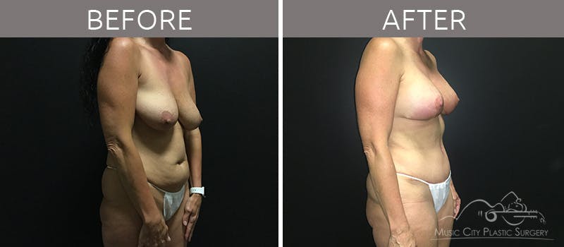 Breast Lift with Augmentation Before & After Gallery - Patient 132099615 - Image 6