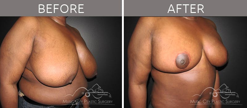 Breast Reduction with Lift Before & After Gallery - Patient 132102654 - Image 4