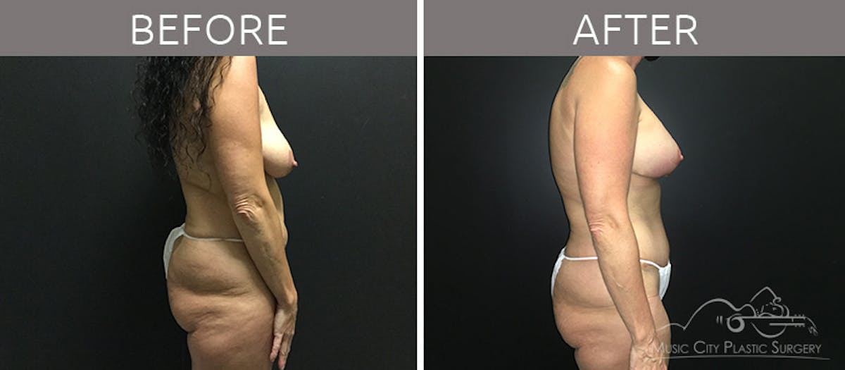Breast Lift with Augmentation Before & After Gallery - Patient 132099615 - Image 5