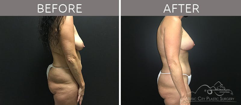 Breast Lift with Augmentation Before & After Gallery - Patient 132099615 - Image 7