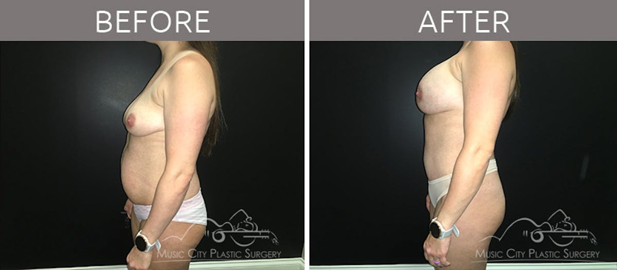 Breast Augmentation Before & After Gallery - Patient 90709277 - Image 3