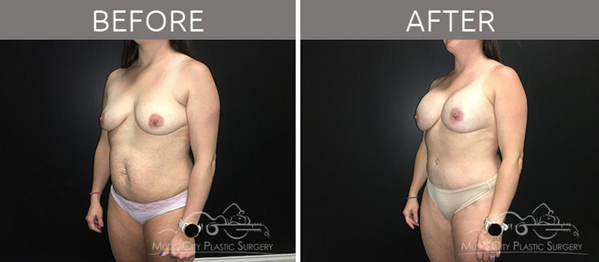 Breast Augmentation Before & After Gallery - Patient 90709277 - Image 2