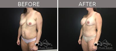 Breast Augmentation Before & After Gallery - Patient 90709277 - Image 2