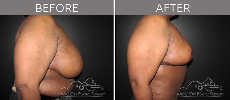 Breast Reduction with Lift Before & After Gallery - Patient 132102654 - Image 5