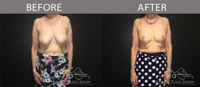 Breast Reduction with Lift Before & After Gallery - Patient 132099784 - Image 1