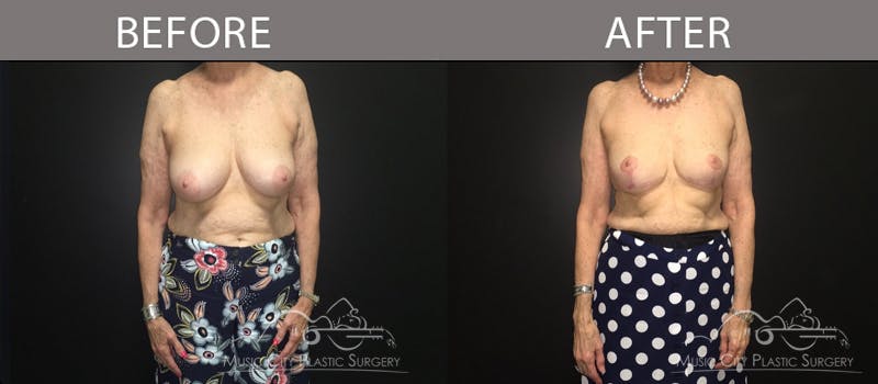 Breast Reduction with Lift Before & After Gallery - Patient 132099784 - Image 1