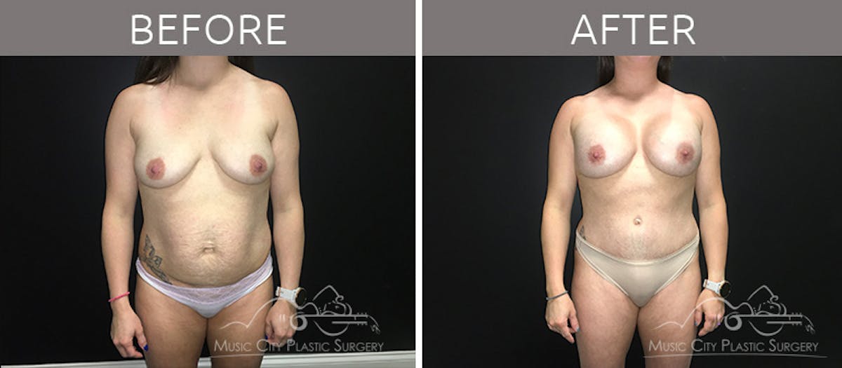 Breast Augmentation Before & After Gallery - Patient 90709277 - Image 1