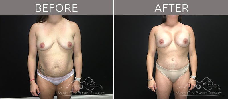 Breast Augmentation Before & After Gallery - Patient 90709277 - Image 3