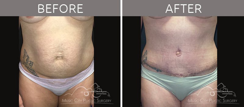 Breast Augmentation Before & After Gallery - Patient 90709277 - Image 4
