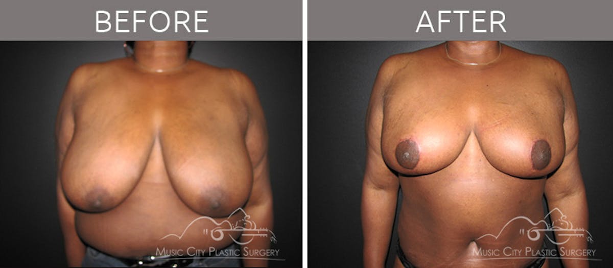 Mommy Makeover Before & After Gallery - Patient 90709278 - Image 1