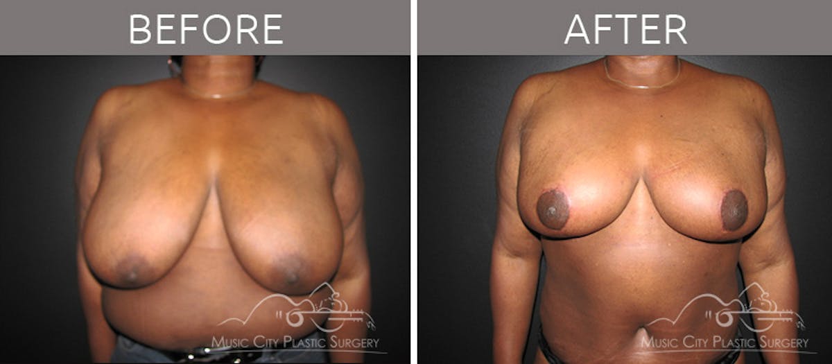 Breast Reduction with Lift Before & After Gallery - Patient 132102654 - Image 1