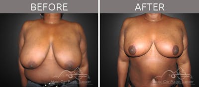 Breast Reduction with Lift Before & After Gallery - Patient 132102654 - Image 1