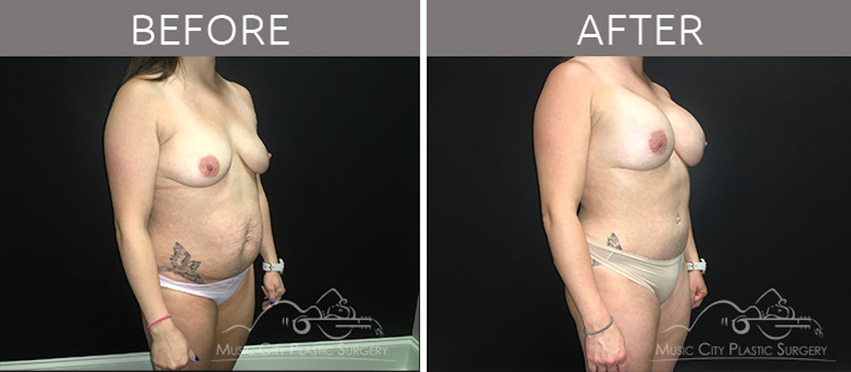 Breast Augmentation Before & After Gallery - Patient 90709277 - Image 4