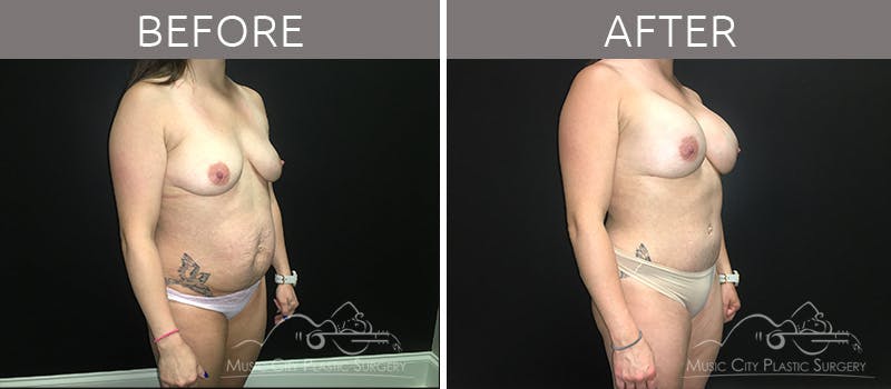 Breast Augmentation Before & After Gallery - Patient 90709277 - Image 5