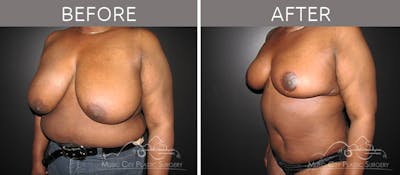 Breast Reduction with Lift Before & After Gallery - Patient 132102654 - Image 2