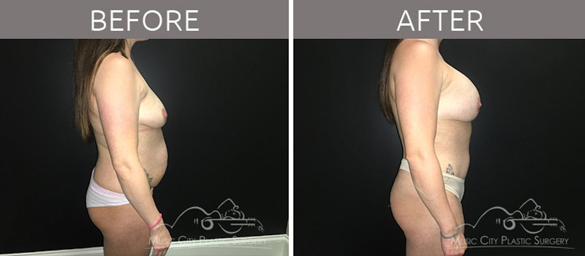 Breast Augmentation Before & After Gallery - Patient 90709277 - Image 5