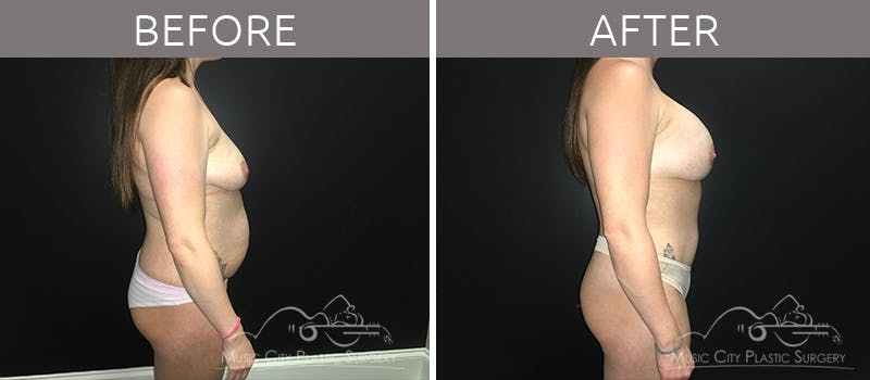 Breast Augmentation Before & After Gallery - Patient 90709277 - Image 6