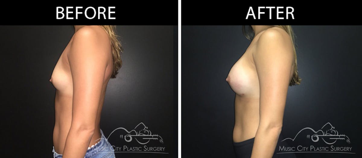 Breast Augmentation Before & After Gallery - Patient 90709279 - Image 3