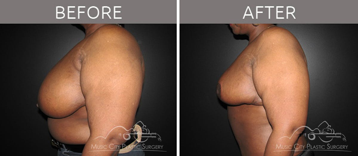 Breast Reduction with Lift Before & After Gallery - Patient 132102654 - Image 3