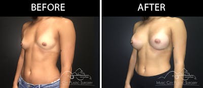Breast Augmentation Before & After Gallery - Patient 90709279 - Image 2