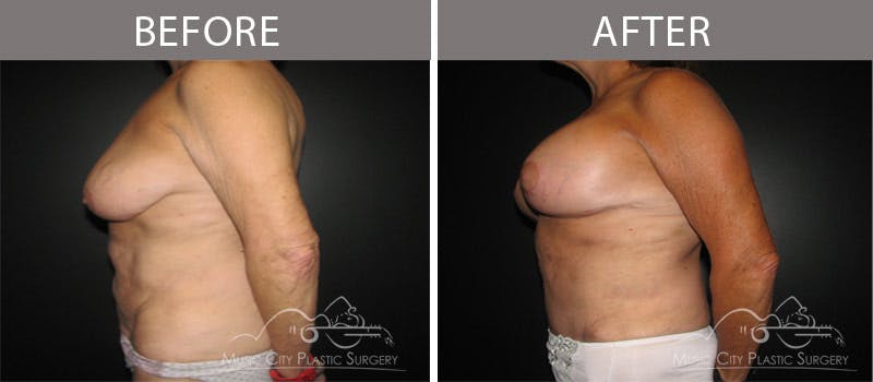 Mommy Makeover Before & After Gallery - Patient 90709280 - Image 2