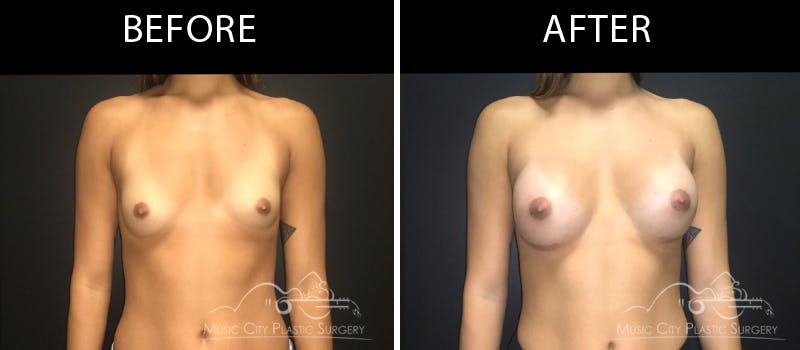 Breast Augmentation Before & After Gallery - Patient 90709279 - Image 1