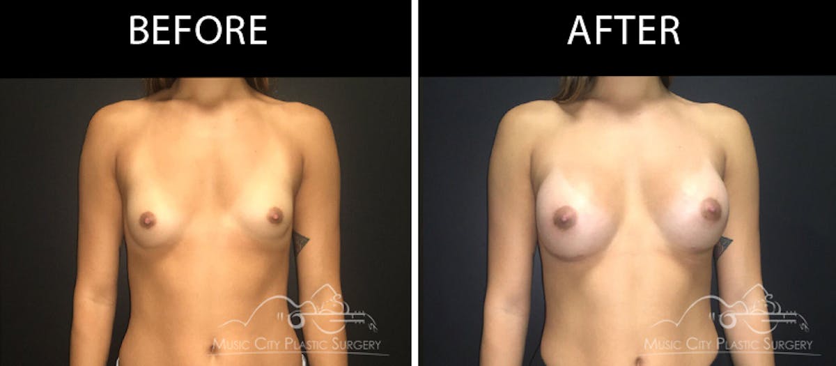 Breast Augmentation Before & After Gallery - Patient 90709279 - Image 1