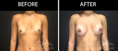 Breast Augmentation Before & After Gallery - Patient 90709279 - Image 1