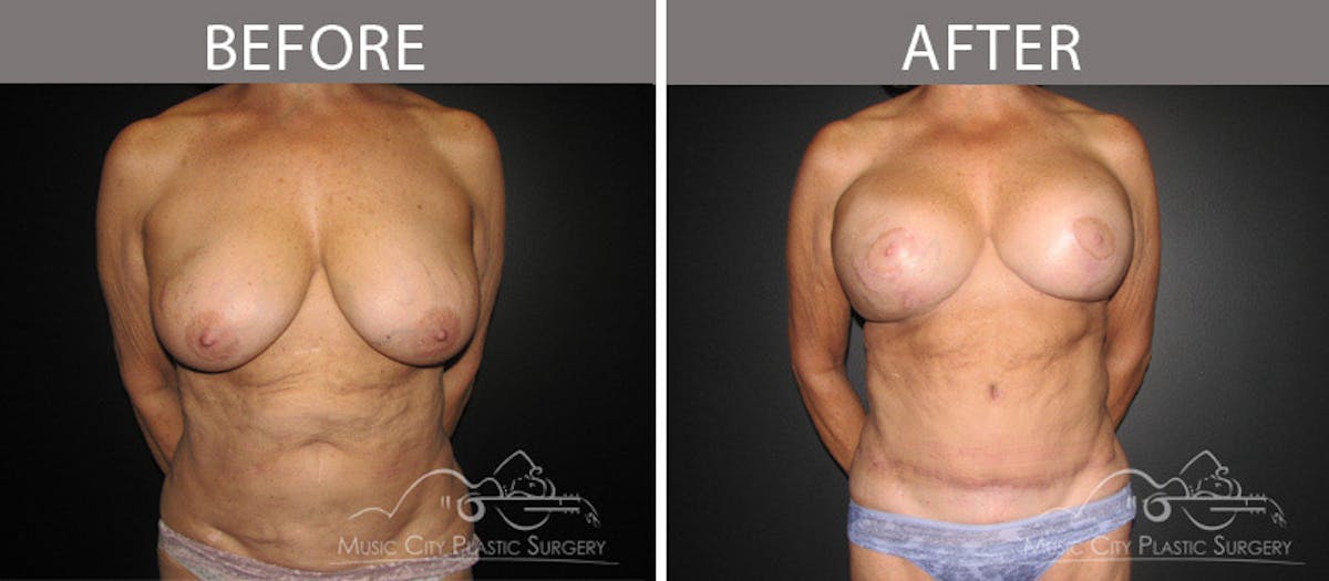 Mommy Makeover Before & After Gallery - Patient 90709280 - Image 1