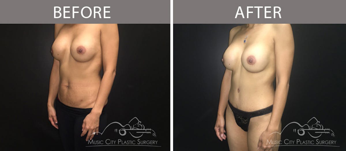 Breast Augmentation Before & After Gallery - Patient 90709294 - Image 2