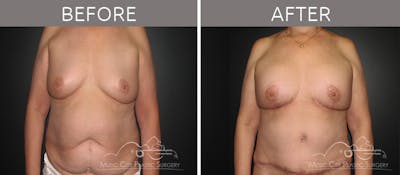 Mommy Makeover Before & After Gallery - Patient 90709293 - Image 1