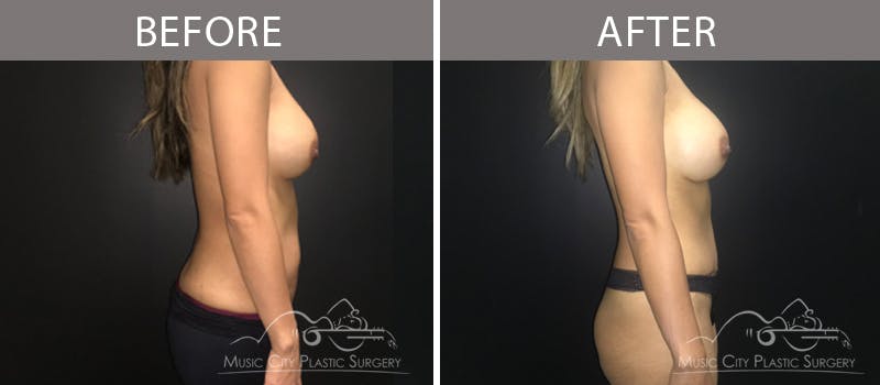 Breast Augmentation Before & After Gallery - Patient 90709294 - Image 3