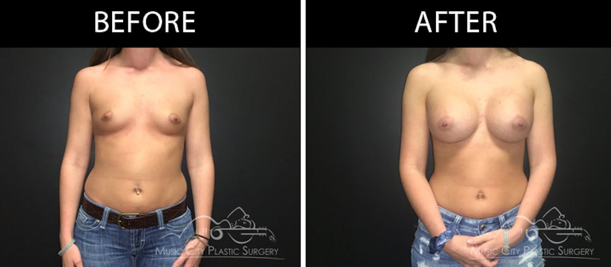 Breast Augmentation Before & After Gallery - Patient 90709299 - Image 1