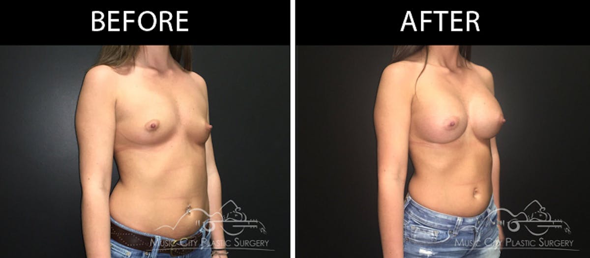 Breast Augmentation Before & After Gallery - Patient 90709299 - Image 2