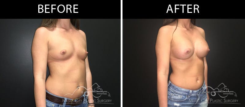 Breast Augmentation Before & After Gallery - Patient 90709299 - Image 2