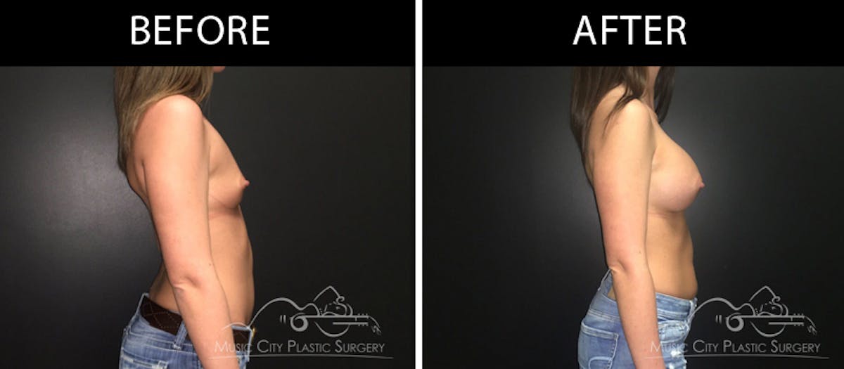 Breast Augmentation Before & After Gallery - Patient 90709299 - Image 3